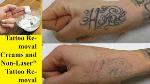 laser-tattoo-remover-qwc